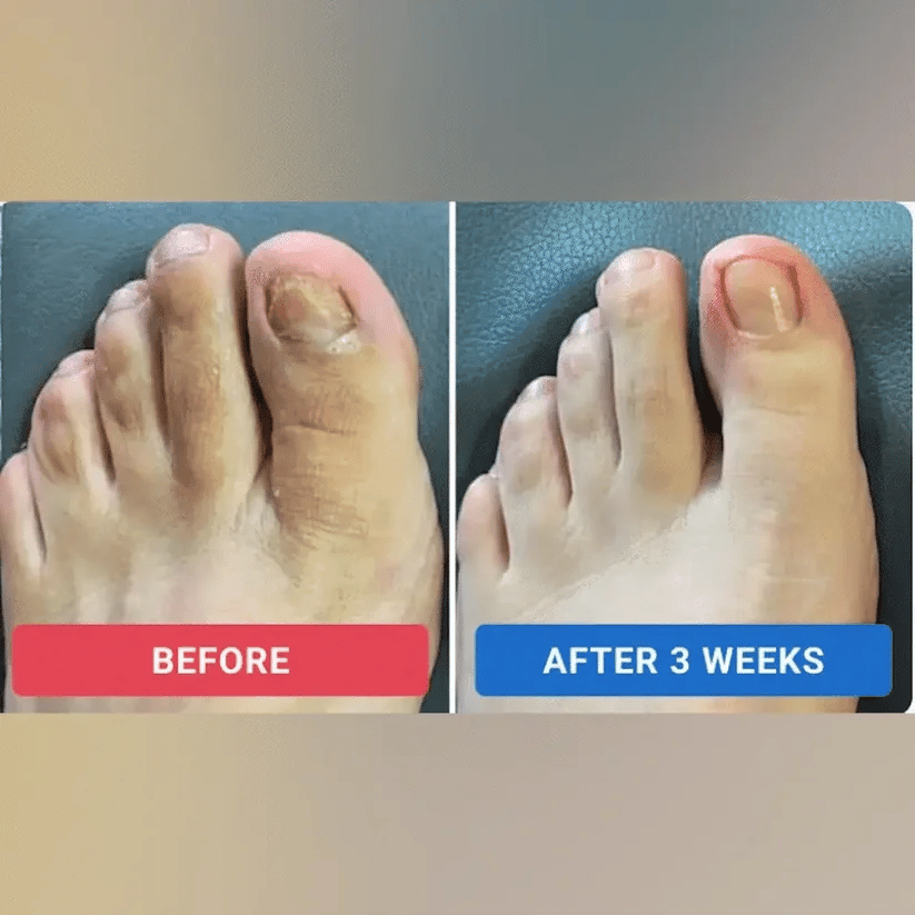 Fungal Nail Renewal Patches