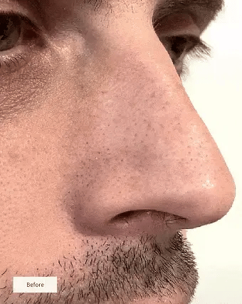 Nose Patches ( Pack of 8 )